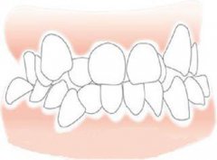 牙列拥挤的错颌畸形都需要拔牙矫