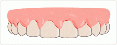 牙结石致使牙龈萎缩怎么办